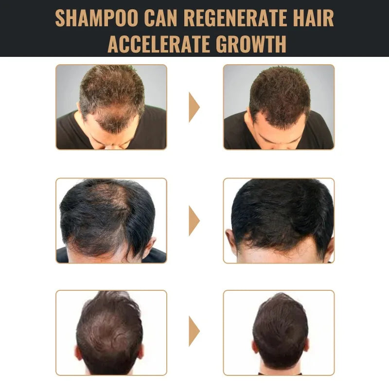 Hair Loss Treatment Shampoo